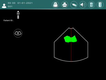 bladder scan easyblad